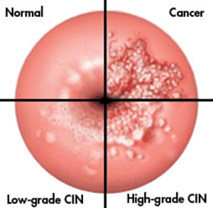 hpv treatment abnormal cells