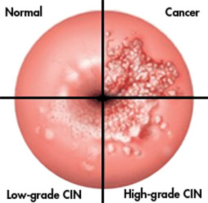 abnormal_cells