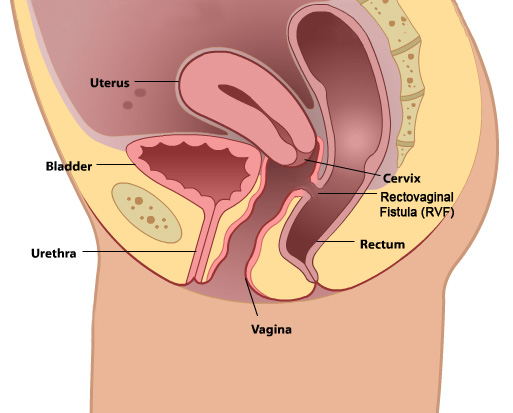 cervical cancer patient journey